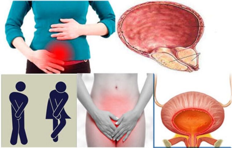 Symptoms of cystitis in women - burning and pain when urinating