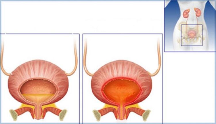 The bladder is normal and with signs of inflammation due to cystitis